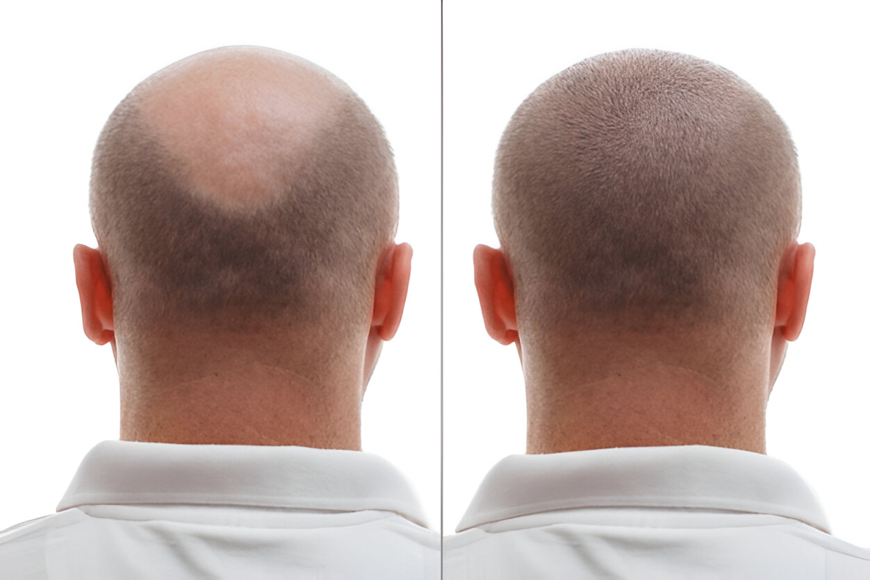 AdGro Jayanagar Hair Clinic - Modern Hair Treatment Facility in Bangalore