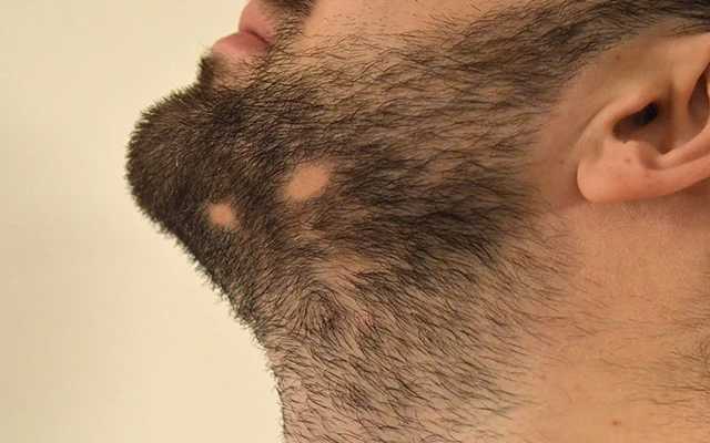 Patchy Beard / Patchy Scalp
