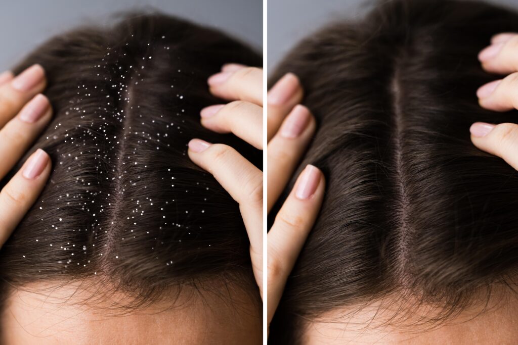 Dandruff / Scalp Issues