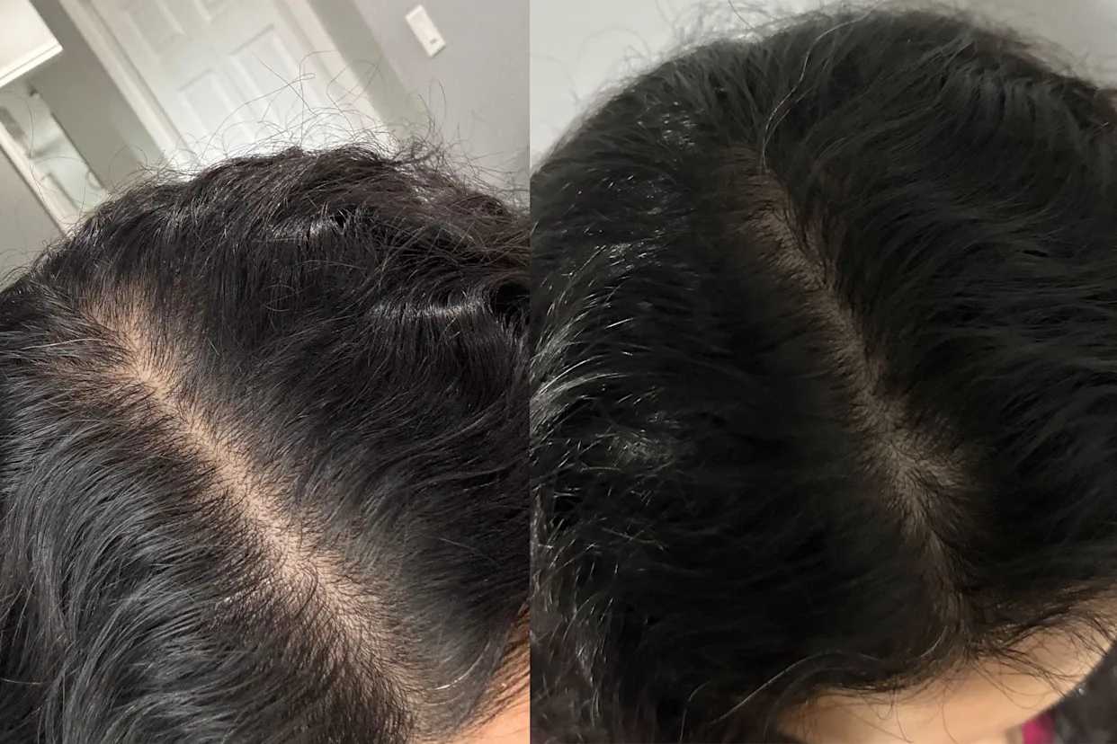 Thinning Hair